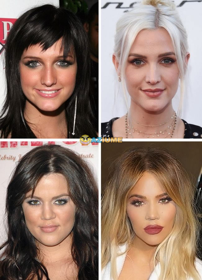 Celebridades antes dos procedimentos estéticos Celebridades antes dos procedimentos estéticos