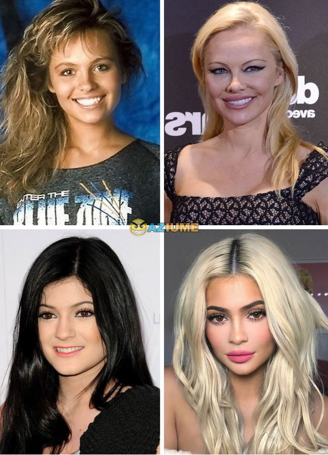 Celebridades antes dos procedimentos estéticos Celebridades antes dos procedimentos estéticos