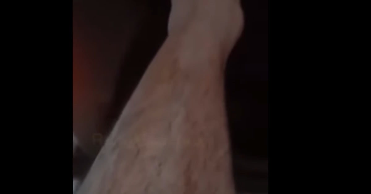 Que estranho, só uma perna que nasce pelos Que estranho, só uma perna que nasce pelos