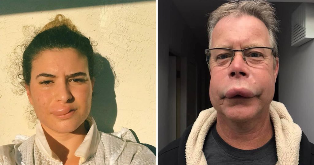 Picadas de abelha: Alternativa natural para preenchimento labial